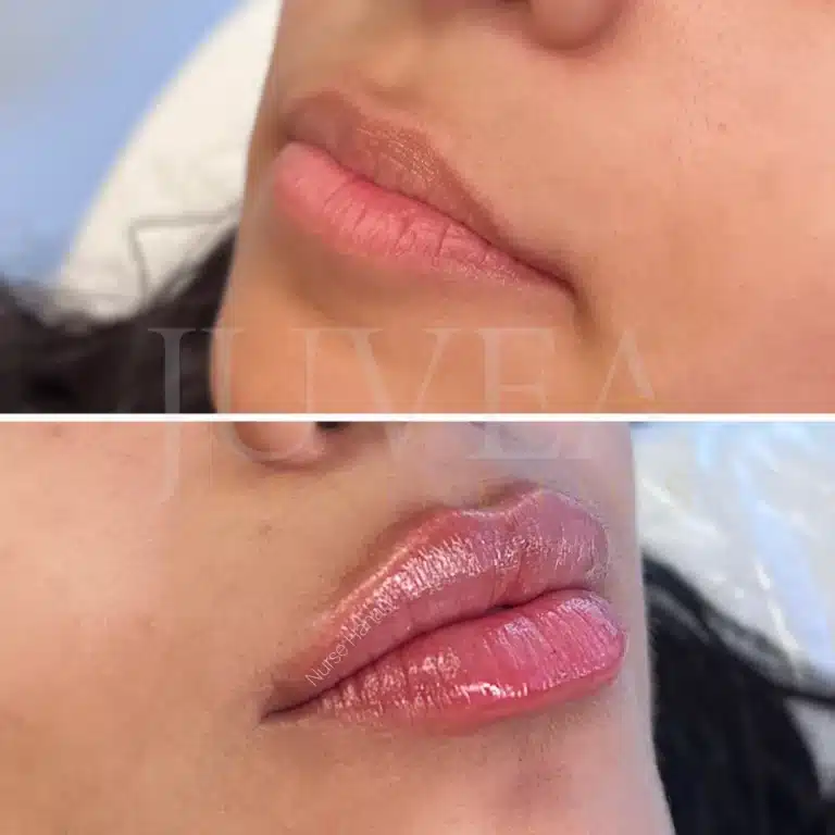 Lip filler In Calgary Before & After