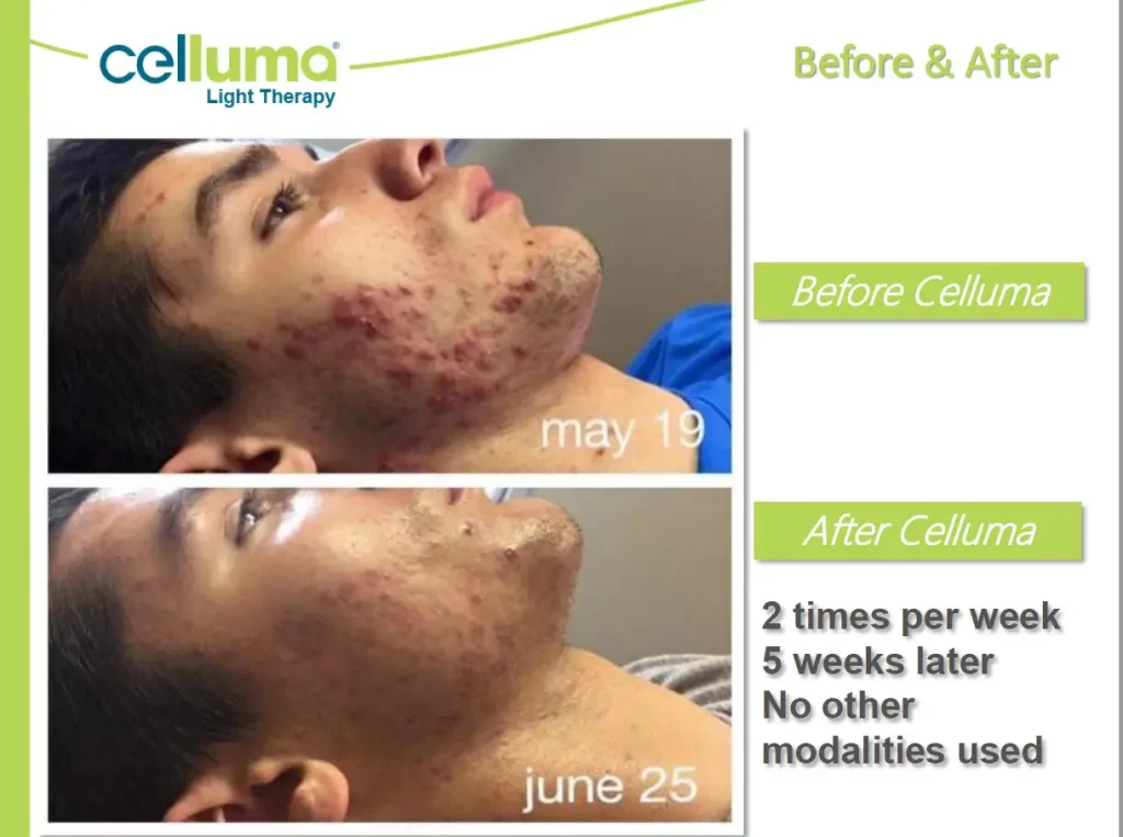 Celluma light therapy before and after