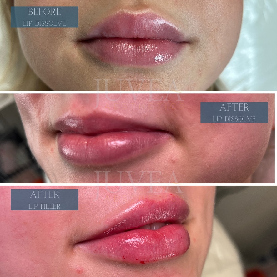 Bad Lip Filler Before, After Dissolving and After Lip Filler Correction