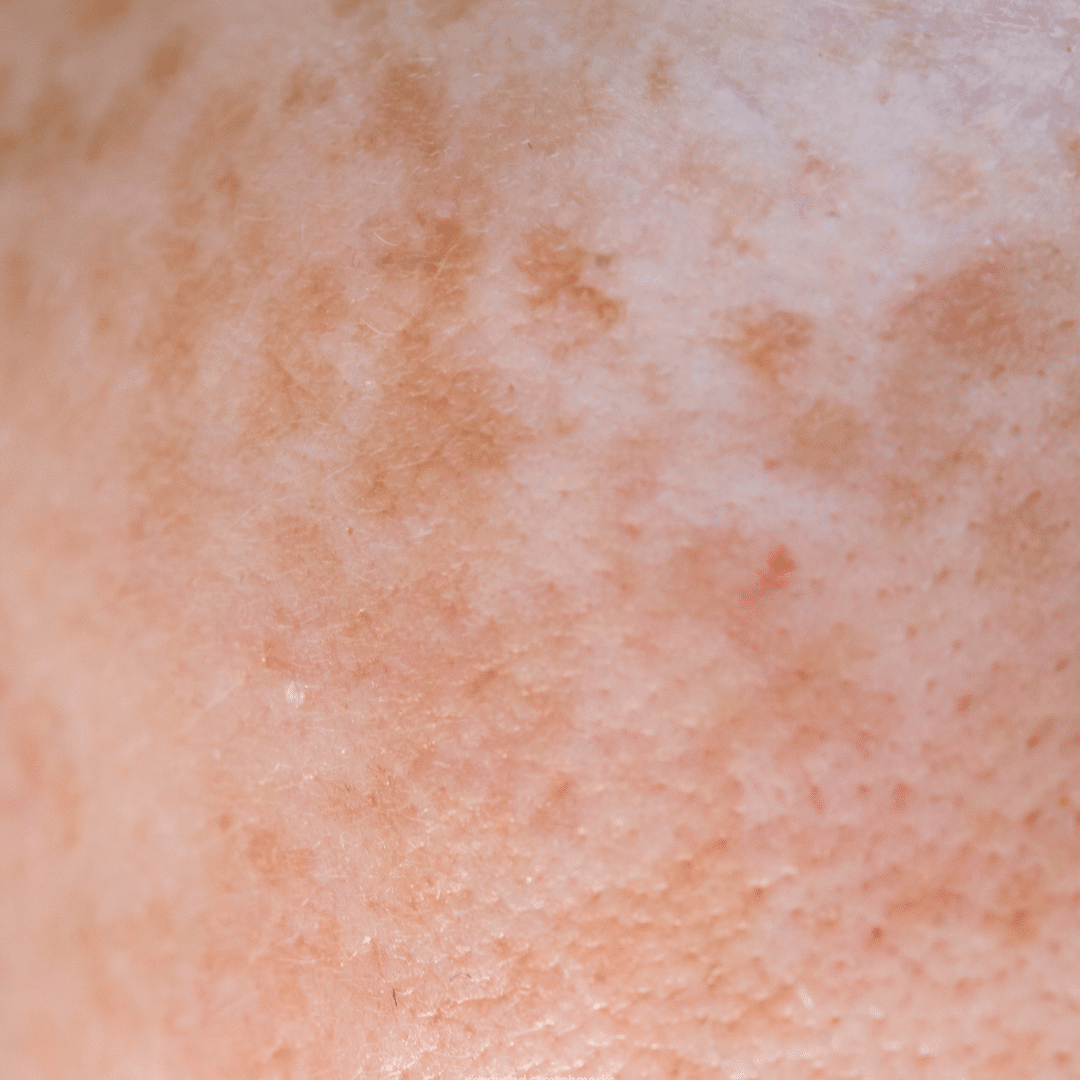 hyperpigmentation