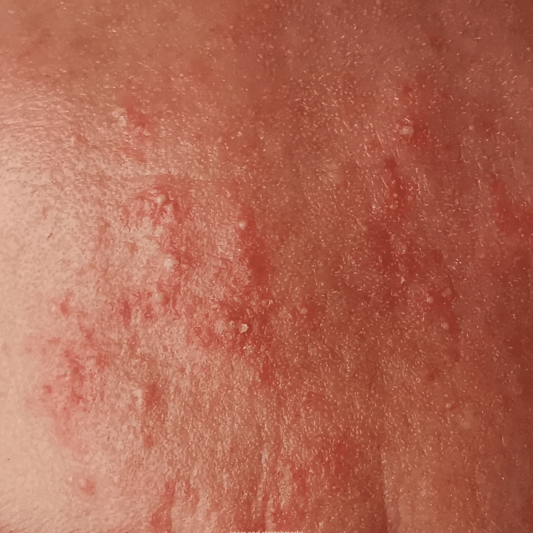 rosacea