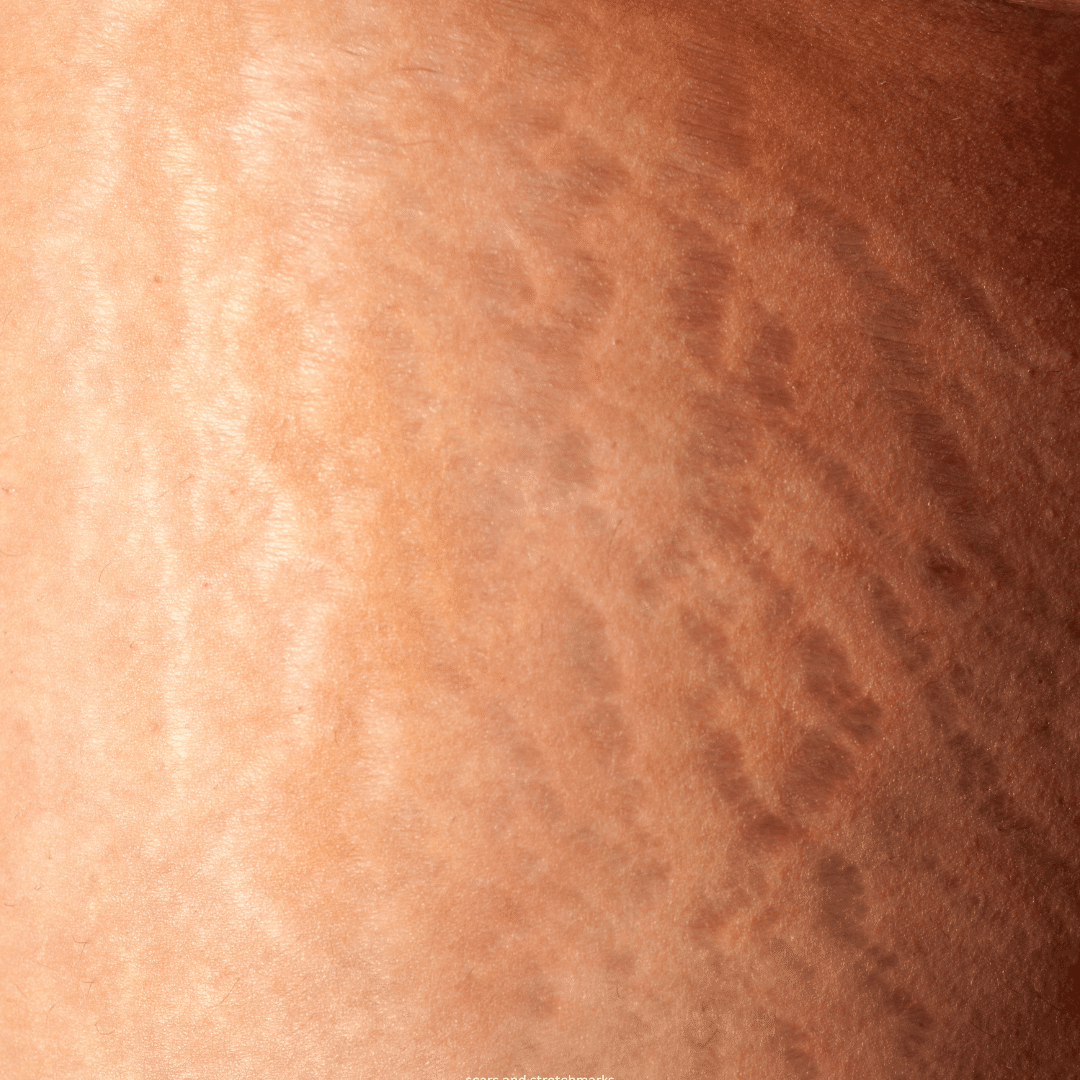 scars and stretchmarks