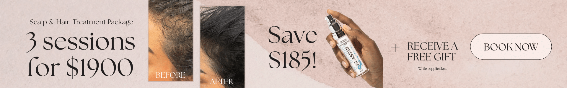 Microneedling hair and scalp treatment package offer. 3 sessions for $1900