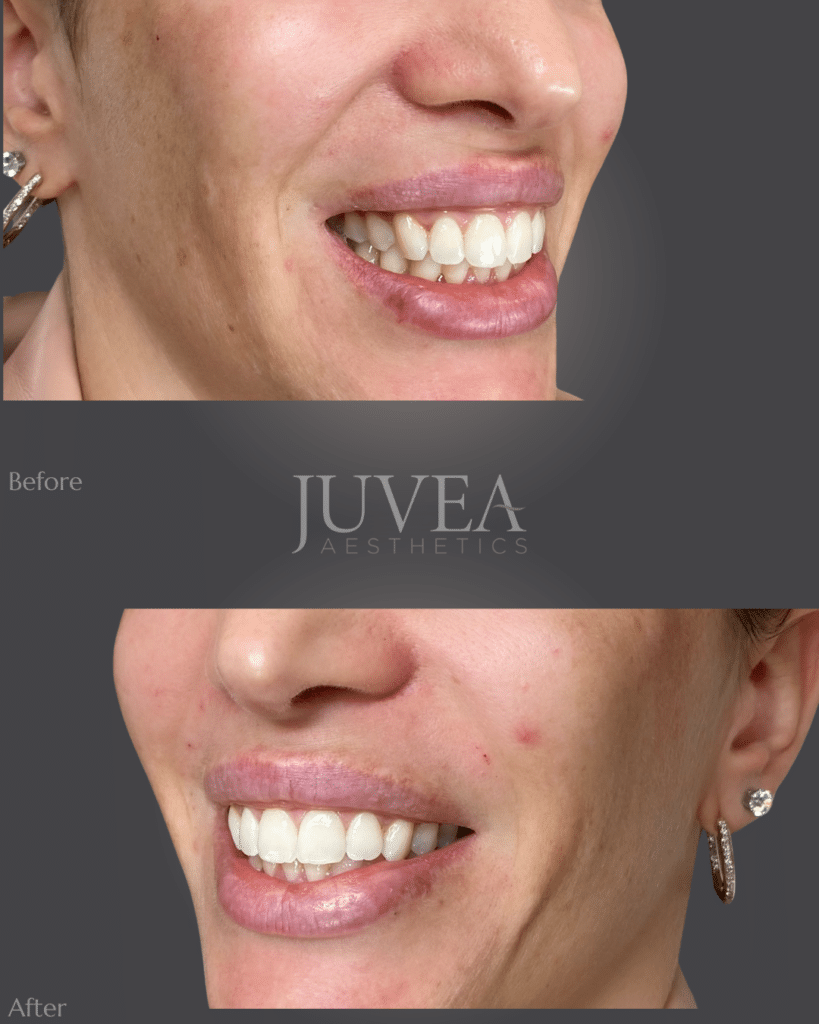 Botox is placed in the upper lip before and after