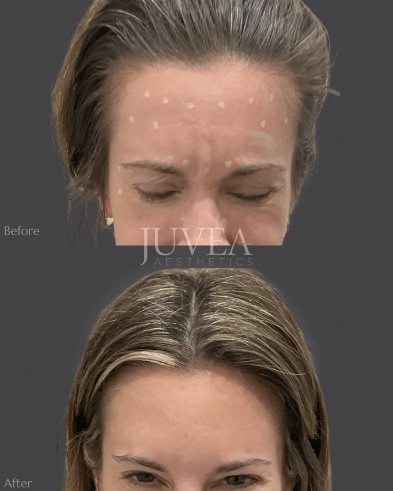Woman with marks for where the botox will be injected in her forhead