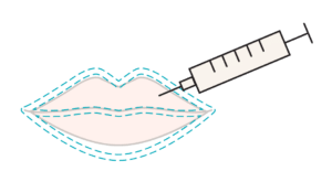Illustration of a classic lip filler injection showing hyaluronic acid placement within the lip body to add volume.