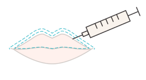 Illustration showing Botox injections into the muscle above the upper lip to create a Lip Flip.