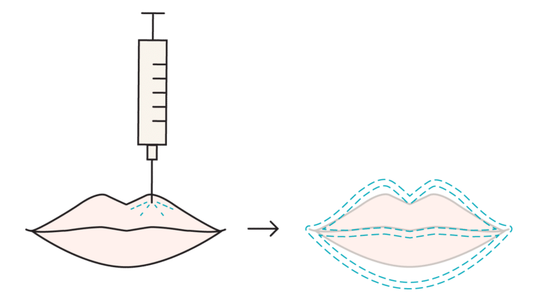 Illustration of Russian lip filler technique showing vertical injections for height and a flat profile.