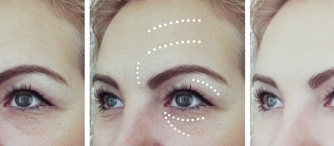 woman wrinkles before and after treatments