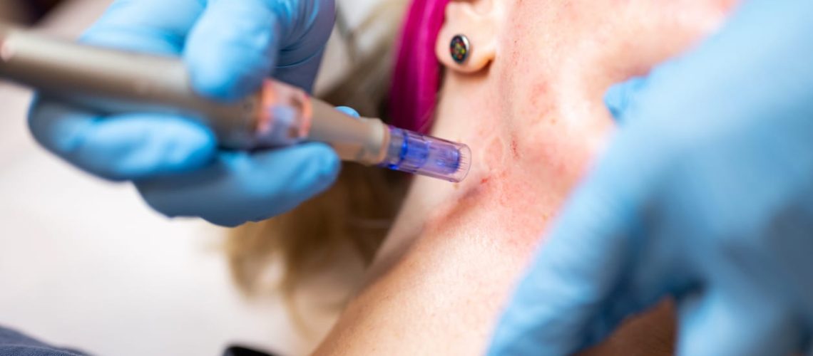 Microneedling